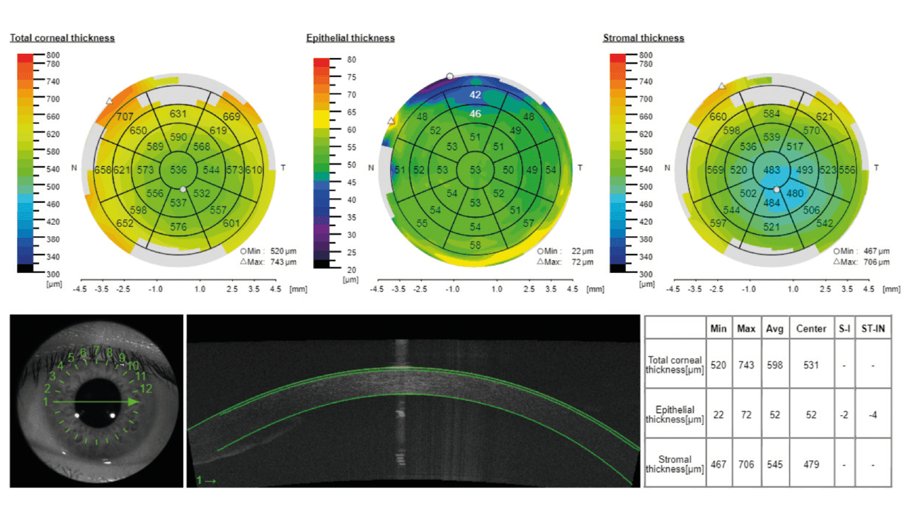corneal-thickness-maps