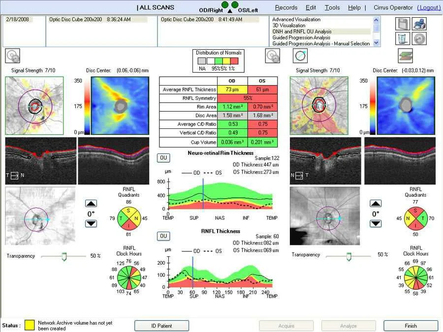 Cirrus 5000 HD-OCT
