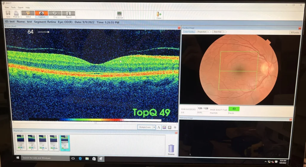 Topcon 3D OCT 2000 FA